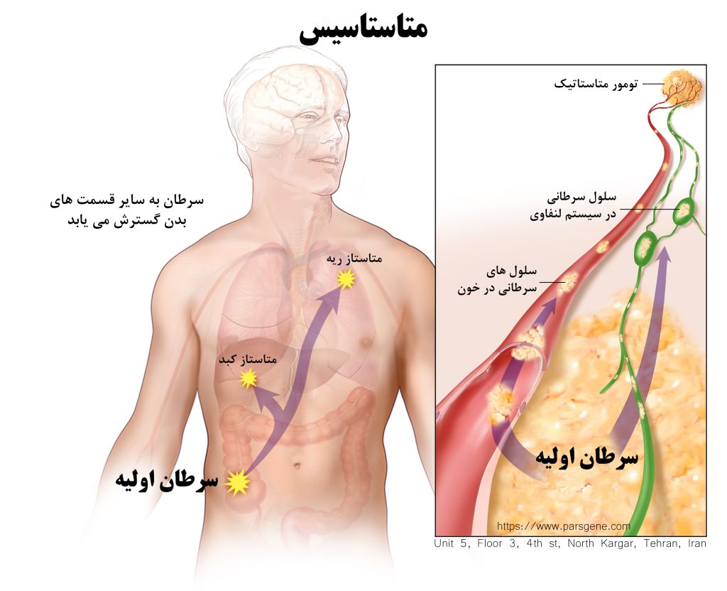 متاستاسیس و متاستاژ