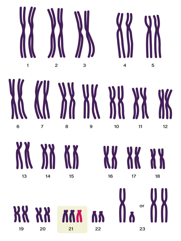 Syndrome Down chromosome problem number 21