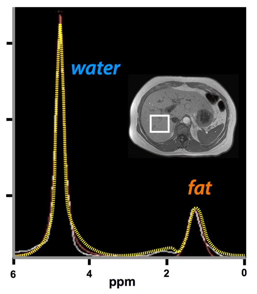 طیف سنجی تشدید مغناطیسی کبد به کمک MRI