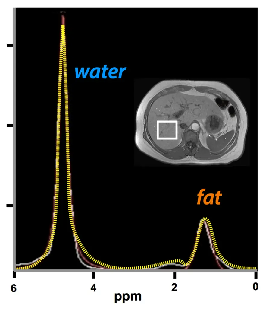 طیف سنجی تشدید مغناطیسی کبد به کمک MRI