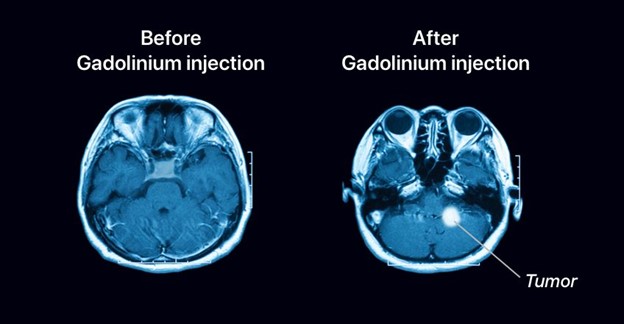 تصویربرداری MRI با کنتراست