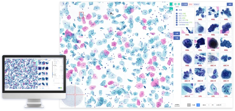 Cervical Cancer Al