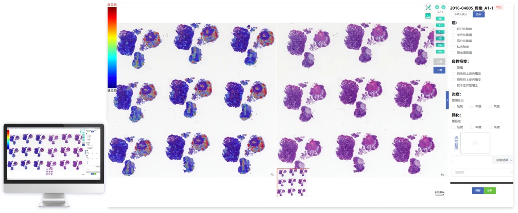 Gastric Cancer Al