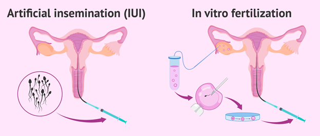 تفاوت روشهای IVF و IUI