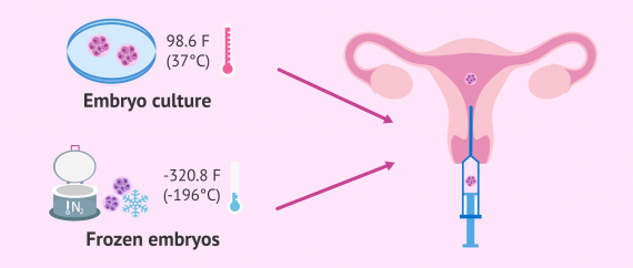 انتقال جنین تازه و منجمد به داخل رحم در IVF