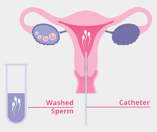 IUI
