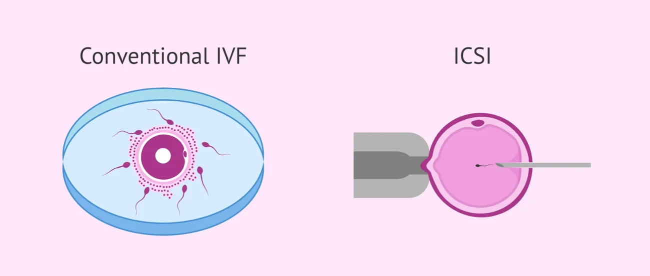 مقایسه IVF معمولی و ICSI