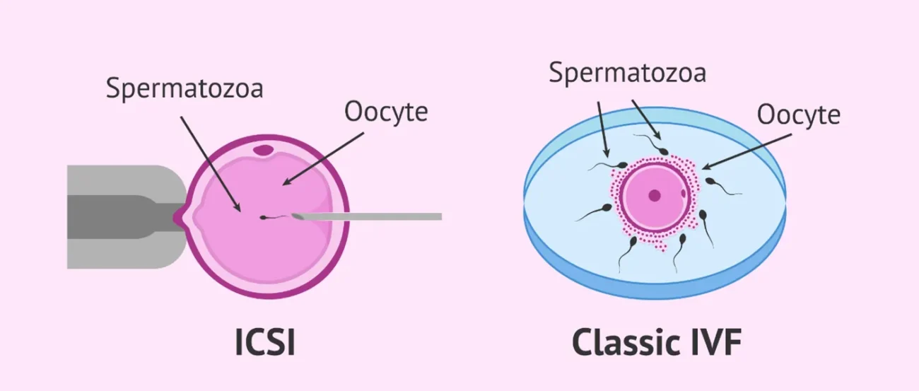 مقایسه IVF و ICSI