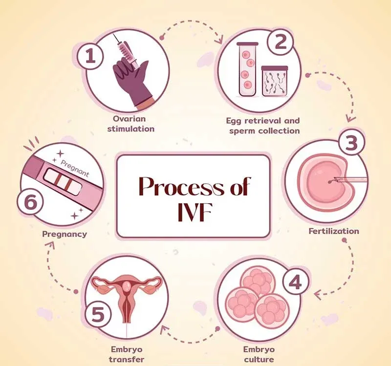 مراحل IVF