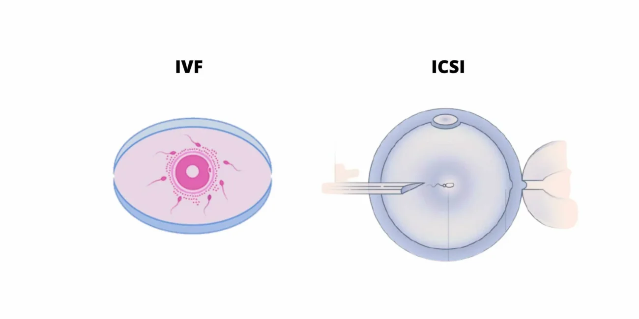 مقایسه تکنیک IVF و ICSI